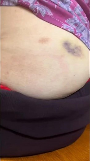 intramuscular injection | IM injection | nursing.