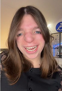 🧿🧿🧿 #handicap #treachercollinssyndrome #humour | treacher collins