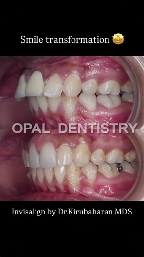 Can Invisalign be done on top of an old crown?