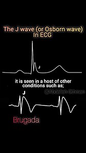 The J Wave (Osborn Wave): J wave, an extra deflection at the QRS-ST junction, is a pivotal ECG finding. While classically linked to hypothermia (where it is termed the Osborn wave), it is not pathognomonic. The accompanying graphic correctly identifies its appearance in: · Acute myocardial ischemia (STEMI) · Acute pericarditis / Myocarditis · Early repolarization (a common benign variant) · Brugada syndrome (coved-type elevation) · Hypercalcemia (short QT) #ECG #Cardiology #JWave #OsbornWave #Hy