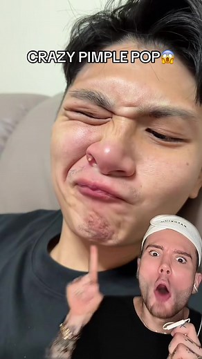 CRAZY PIMPLE POP!😱 (Follow for more!💗) Skincare ASMR, Popping Back Pimples