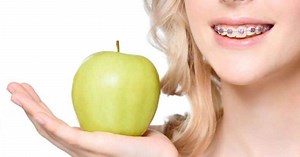 20 Foods to Avoid With Braces — Avoid Broken Wires and Brackets