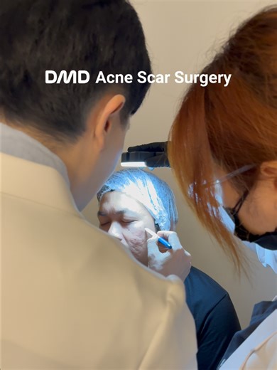 Effective Acne Scar Surgery for Lasting Results