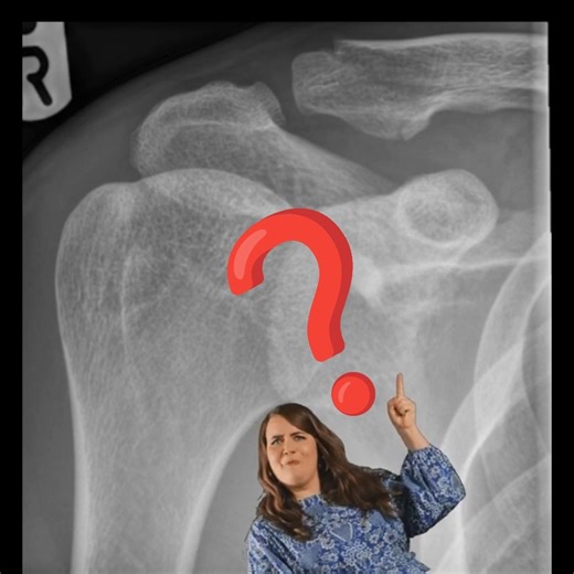 Distal clavicle fracture