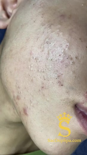 Đánh giá Sắc Đẹp Spa: Hiệu quả từ điều trị mụn