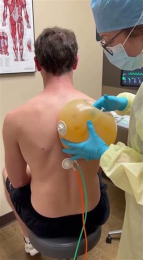 Back skin Acne removing process