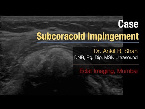 #MSK Ultrasound - Subscapularis tendon calcification Subcoracoid Impingement