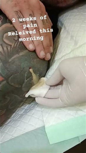 it finally burst 🙌🏽🙌🏽💪🏽 the abscess is draining