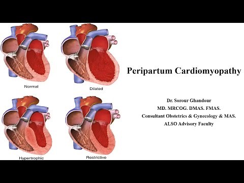 Peripartum Cardiomyopathy - MRCOG Part 2 & 3 Task