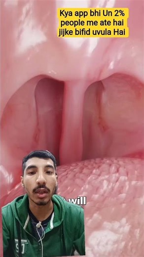 Gale Me 2 Ghanti? 😱 Bifid Uvula Kya Hai? #shorts #facts #medical