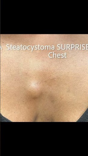 Surprise Steatocystomas