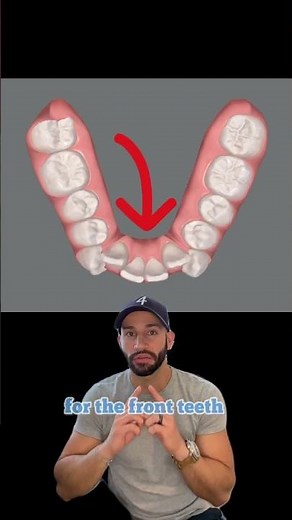 How does Invisalign work: A Case Review. 2023