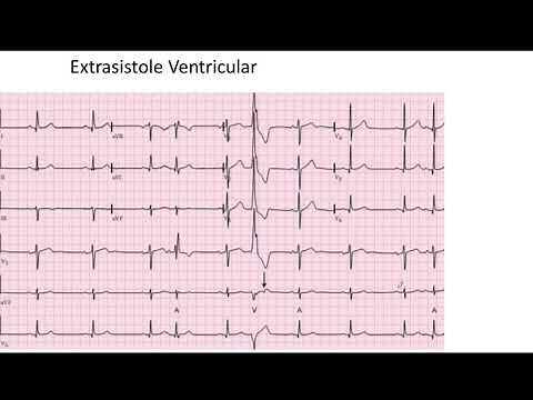 Extrasistole Auricular y Ventricular EKG