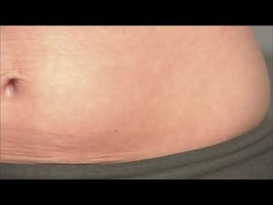 Subcutaneous Injection - Instructions