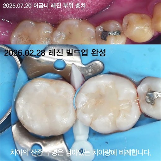 레진 치료한 어금니 충치. 레진빌드업 치료 사례
