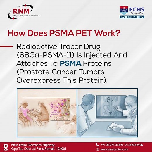 Prostate Cancer PSMA PET-CT scan is an imaging test used to detect prostate cancer | RNM Center