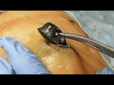 Blackhead Extraction - Abscess Drainage - Acne, Zit & Pimple Removal - Cyst Popping this week #8