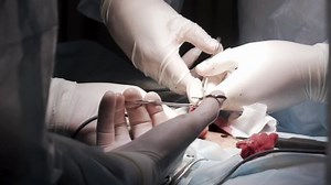 Surgical Team Operating Male Genitals Operation: стоковое видео (без лицензионных платежей), 1057359400 | Shutterstock