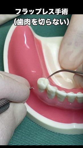 フラップレス手術のモデル解説とインプラント情報