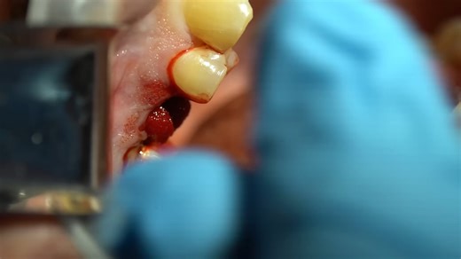 Step-by-Step Extraction and Immediate Implant Surgery (Full Length)