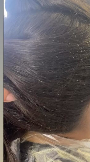 121K views · 51 reactions | When Nits on the hair appear white and further from the scalp, it is because the infestation has been going on for some time. The nits have hatched and only the empty shell remains. #facts #factsoflice #rgvlicelady | LRS - Lice Removal Service | Facebook