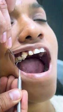 Nance Appliance Explained | Dr. Kapil Saroha