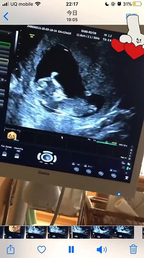 こっち向いたの👼🏻💗#3人目妊娠中