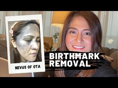 9th Session | Nevus of Ota Birthmark Removal using Laser | Qswitch ND-Yag