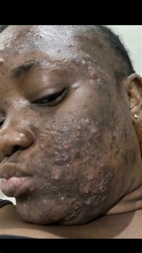 #reparationcutanee #skincare #acne #taches #bienetre | acne visage