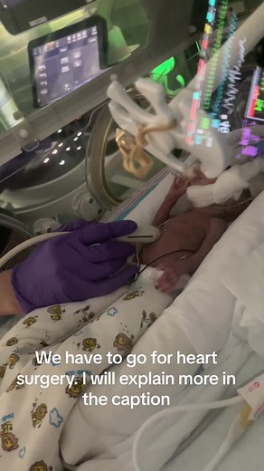 Legend had to go for heart Surgery. He had something called PDA. What is a PDA? PDA stands for Patent ductus arteriosus (PDA) surgery is done to close a blood vessel called the ductus arteriosus. Normally, this blood vessel closes after birth. But in PDA, it stays open. This causes some of the blood that should go from the heart to the body to go to the lungs instead. which was making his oxygen go down. Thank god and thanks to all of your prayers, surgery went well.🙏🏽🙏🏽🤍#b#bebeprematuroext