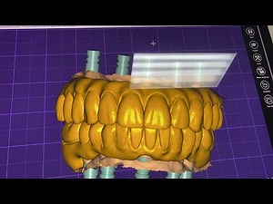 All on 4 Dental Implants Bridge Design