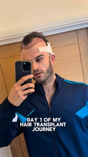 Day 1 to Day 326 of my Hair Transplant and what a journey it has been 😂 being honest I thought this month would have played out a lot different with my transformation results but with something exciting that had happened, the hair has gone and I’m rocking the buzz cut look 👀 I have to admit even though it makes it look more obvious that I’ve had a hair transplant, I actually really love it 😂 it’s started so much more of a conversation in person with people, talking about hair transplants and 
