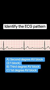 65-year-old man presents with dizziness and near-syncope. #ECG #ecgchallenge #cardiology #fblifestyle #criticalthinking #AcademicAchievement #education | Dr-Yash Med