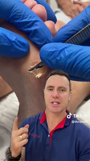 Severe Callus Removal Treatment by Podiatrist in Australia