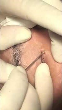 Removal of sebum plug using 18g needle