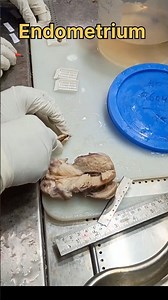 Endometrium tissue processing 😞| #histopathology #tissuerepair #endometriosis #endometriumcancer
