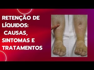 Retenção de Líquidos: Causas, Sintomas e Tratamentos