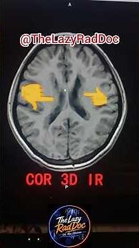 Epilepsy Brain MRI Mystery Case Explained-Bilateral Heterotopia, Hippocampal Atrophy, Arachnoid Cyst
