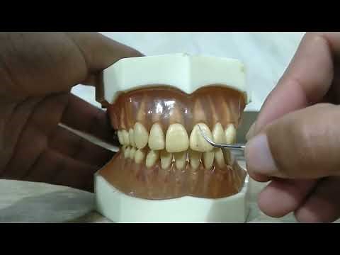 Technique For Ultrasonic Scaling