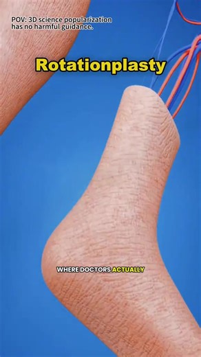 Understanding Rotationplasty Prosthetic Surgery