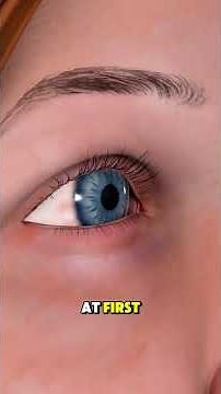 How PRK Eye Surgery Is Performed | Complete Step-by-Step Explanation #medicaleducation