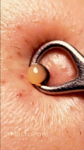 Clinical Macro Extraction | Sebum Release in 4K