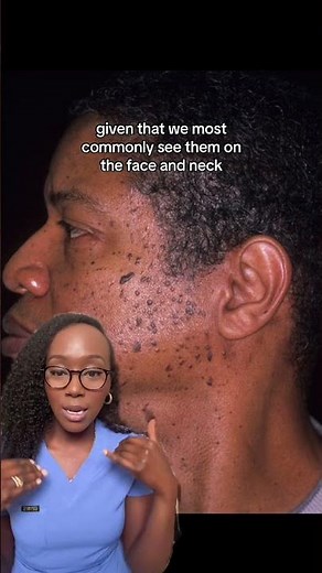 Causes of Brown Bumps on the Face (Dermatosis Papulosa Nigra DPN) and Treatment