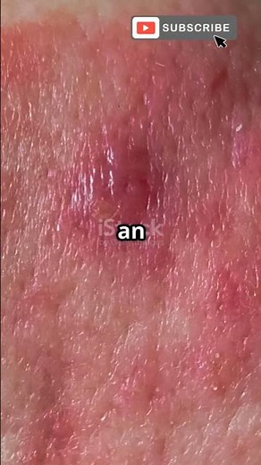 Microsporum canis: The fungus behind ringworm in pets & people! 🐾 #Ringworm #FungalInfections.