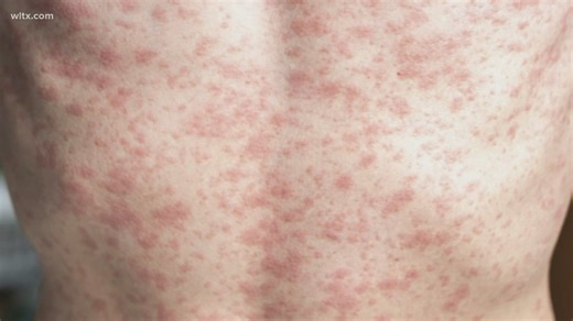DPH reports 6 new cases of measles in Upstate South Carolina, bringing total number to 985