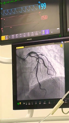 Coronary angiography test in right radial artery in cath lab #producer#angiogram#heart #hospital