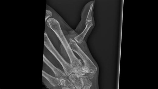 👍 Total joint arthroplasty is a great solution for patients with painful thumb CMC osteoarthritis. 💡 In this video I share the surgical technique how to tackle a case with extreme hyperextension… | Joris Duerinckx, MD PhD | 34 comments