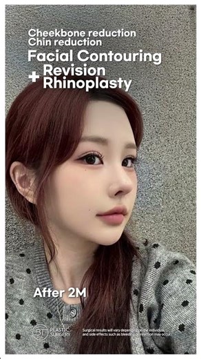 3-Set FC & Revision Rhinoplasty Before and After, BT Plastic Surgery