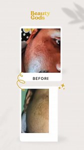 BeautyGods Advanced Brightening Face Cream is packed with Vitamin C, Niacinamide & Alpha Arbutin—working together to reduce pimples, fade acne scars, and bring back that clear, healthy glow! No dryness. No irritation. Just real results. Order now | Beauty Gods Care