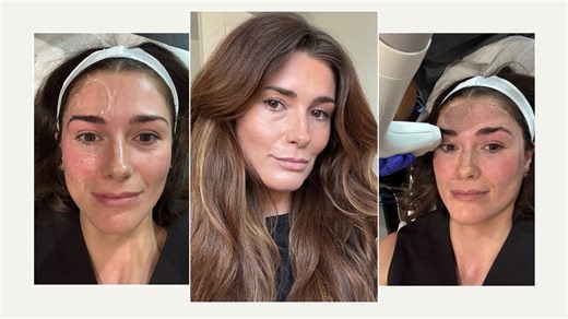 This Lifting and Sculpting Treatment Is Dubbed a Botox Alternative–Here Are My Receipts After 3 Months